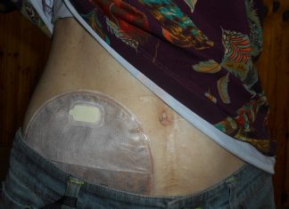 Gesina, die Stoma-App Ein Ileostoma, auf welchem ein Stomabeutel klebt. Foto: Salicyna (CC BY-SA 4.0)