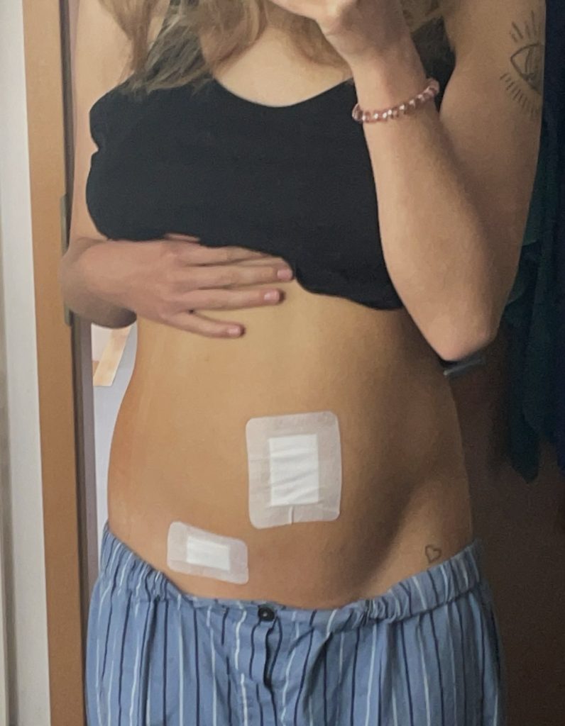 Ein Spiegelselfie einer jungen Frau zeigt ihren Bauch mit zwei Pflastern. Das eine über dem Bauchnabel, das andere etwas tiefer auf ihrem Unterbauch.